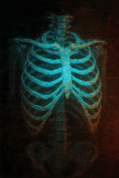 Xray